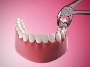 3d rendered illustration of a tooth extraction