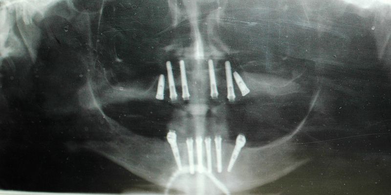 Dental X rays