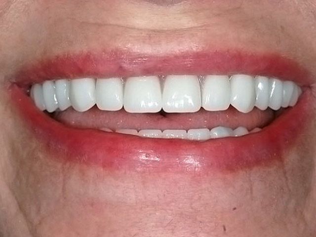 White Teeth Smilling