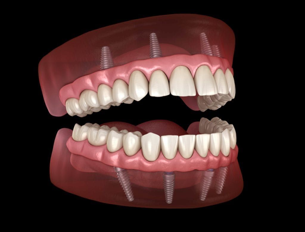Computerized model of implant supported dentures
