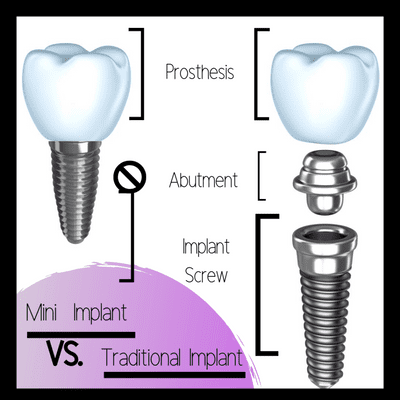 Mini Implant vs Traditional Implant