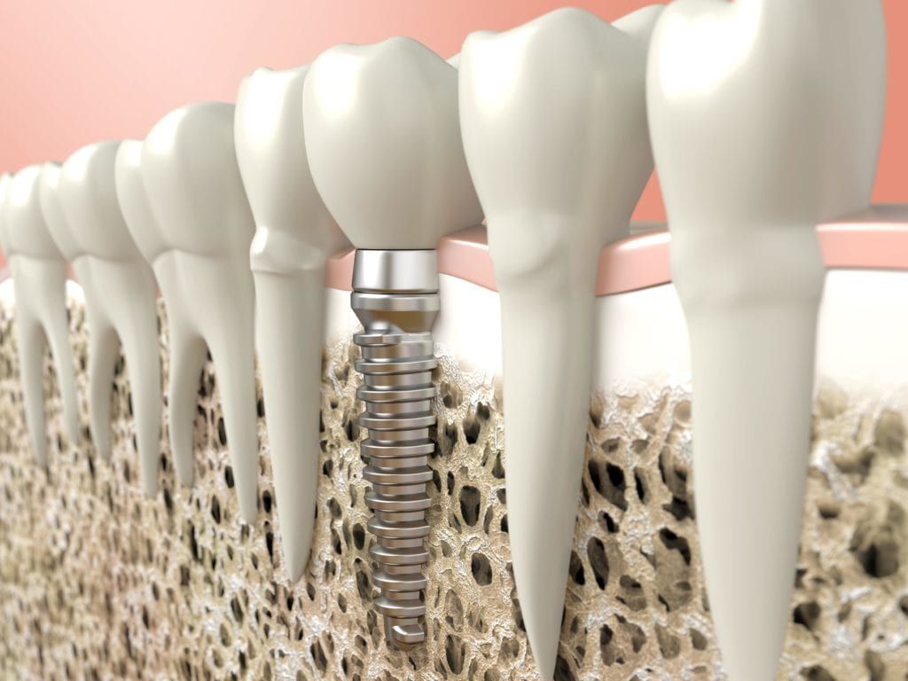 Dental implant shown in jawbone