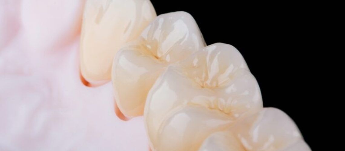 High-quality,Naturally,Dental,Single,Crowns,Made,Of,Zirconium,For,Fixation